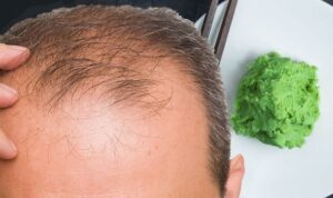 New Research Links Causes Of Hair Loss To Nutritional Deficiency