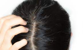 Hair Loss Scalp Disorder: Seborrheic Dermatitis