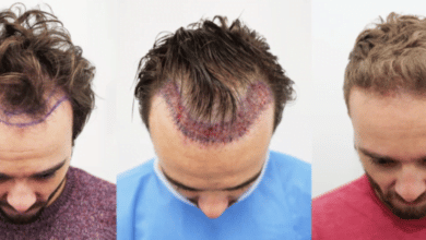 best Hair Transplant Methods