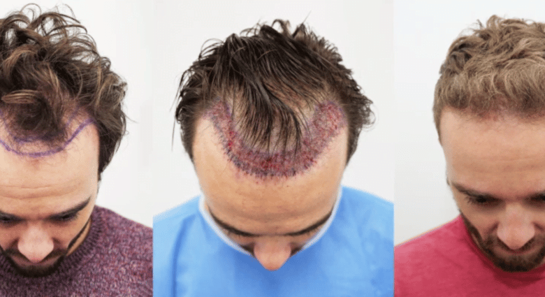 best Hair Transplant Methods