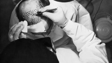 The History of Hair Transplant