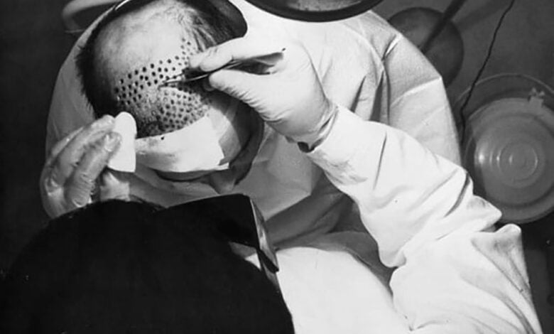 The History of Hair Transplant