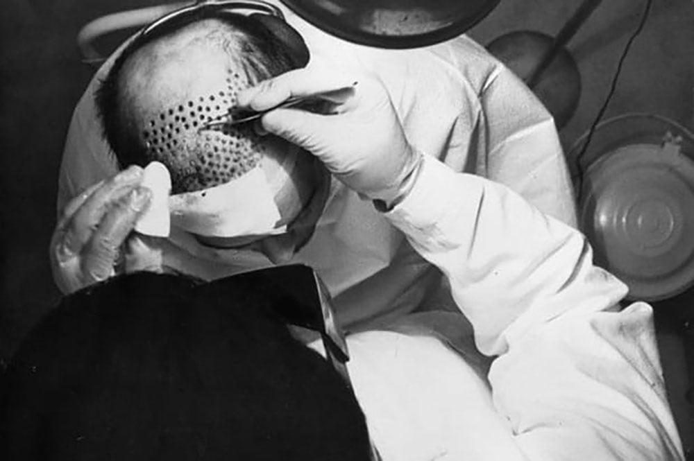 The History of Hair Transplant