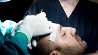 How to Find a Good Hair Transplant Surgeon