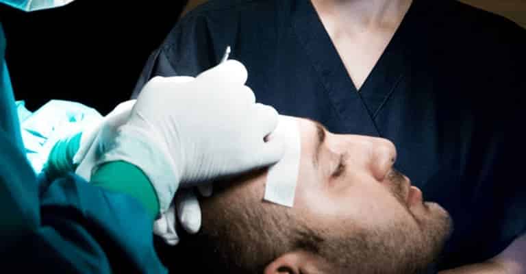 How to Find a Good Hair Transplant Surgeon